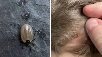 Photo of The Little Scalp Invader! What Parents Should Do When a Strange Bug Appears in Their Childs Hair!
