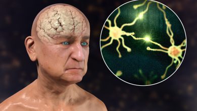 Photo of 10 signs of dementia you should never ignore – and the habits you should start today