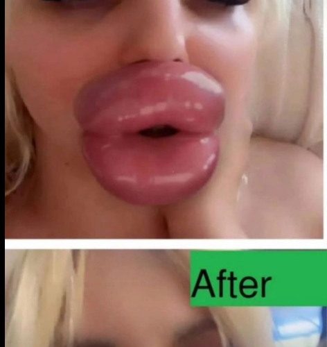 ST. I’ve had so much filler I’m more lips than human – trolls say I look like a duck, but I want them even bigger