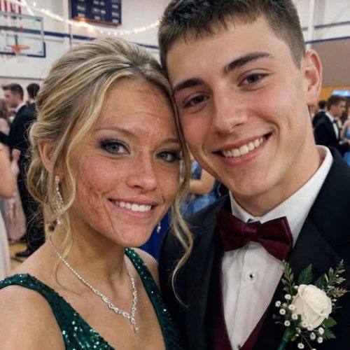 A Boy Asked Me to Dance at Prom Because No One Else Would Due to My Scars – The Next Day, His Parents and Officers Showed up at My Door