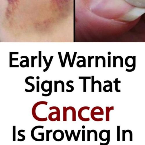 20 Early Warning Signs That Cancer Is Growing In Your Body